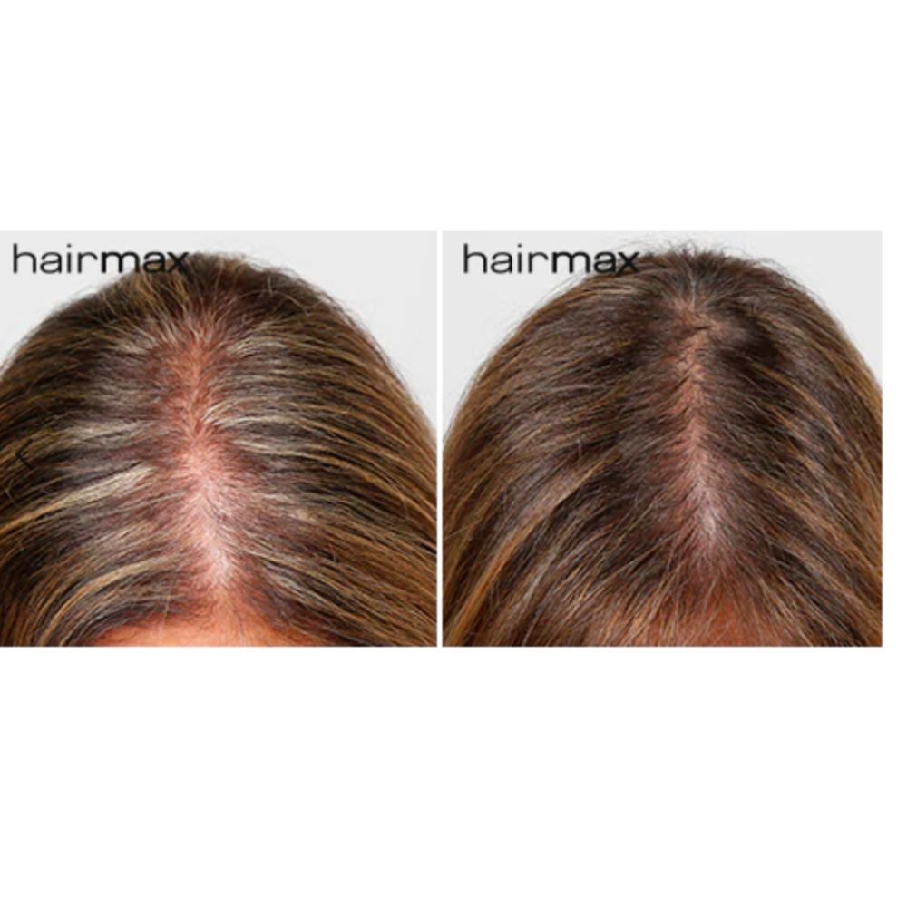 HairMax LaserBand 82 - ComfortFlex lāzerķemme-stīpa